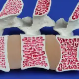 Model kręgosłupa z widoczną osteopenią. Kości są porowate, z rzadką beleczkową strukturą, co świadczy o osłabieniu tkanki kostnej.