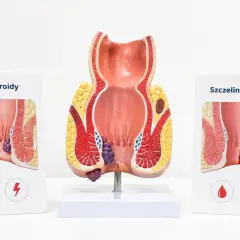 Model anatomiczny odbytu z hemoroidami i szczeliną. Ból odbytu może być objawem tych schorzeń.