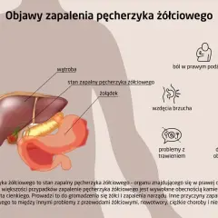Ilustracja przedstawia anatomię jamy brzusznej z zaznaczonymi wątrobą i żołądkiem. Obok wymieniono objawy zapalenia pęcherzyka żółciowego: ból, wzdęcia, wymioty, problemy z trawieniem i dyskomfort.