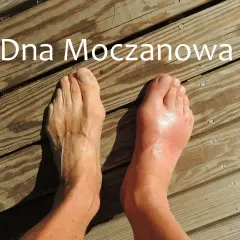 Dwa stopy na drewnianym tarasie. Jedna zdrowa, druga z obrzękiem i zaczerwienieniem, objawem dny moczanowej.