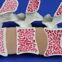 Model kręgosłupa z widoczną osteopenią. Kości są porowate, z rzadką beleczkową strukturą, co świadczy o osłabieniu tkanki kostnej.