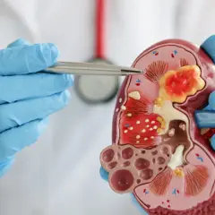 Lekarz w niebieskich rękawiczkach pokazuje model nerki z widocznymi zmianami, sugerującymi podwyższoną kreatyninę.