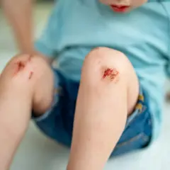 Dziecko z otartymi kolanami. Wczesne objawy tężca mogą obejmować drobne skaleczenia i otarcia, które wymagają uwagi.