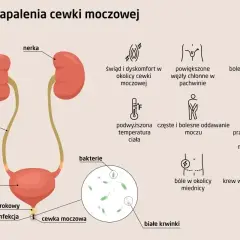 Objawy zapalenia cewki moczowej: świąd, ból, gorączka, krew w moczu, bolesny wytrysk. Infekcja cewki moczowej.