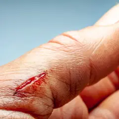 Krwawiące, otwarte skaleczenie na palcu, które może wskazywać na zakażenie rany.
