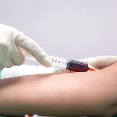 Pobieranie krwi do badań. Ręka pacjenta, strzykawka z krwią i rękawiczka medyczna. MPV.