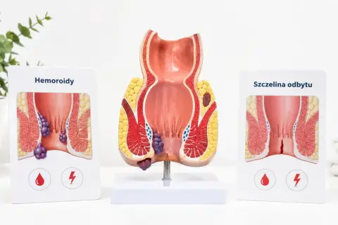 Model anatomiczny odbytu z hemoroidami i szczeliną. Ból odbytu może być objawem tych schorzeń.