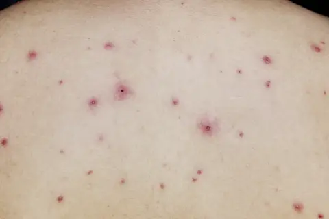 Skóra pleców z licznymi, czerwonymi wykwitami i strupkami, charakterystycznymi dla ospy u dorosłych.