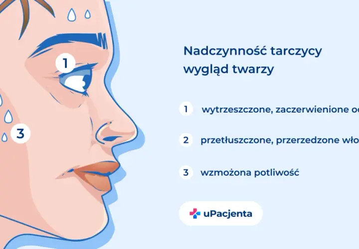 Nadczynność tarczycy objawia się wytrzeszczem oczu (1), przetłuszczonymi włosami (2) i wzmożoną potliwością (3).