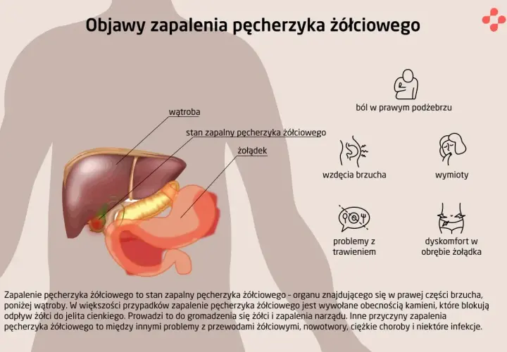 Ilustracja przedstawia anatomię jamy brzusznej z zaznaczonymi wątrobą i żołądkiem. Obok wymieniono objawy zapalenia pęcherzyka żółciowego: ból, wzdęcia, wymioty, problemy z trawieniem i dyskomfort.