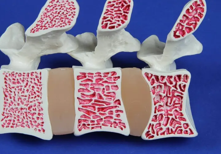 Model kręgosłupa z widoczną osteopenią. Kości są porowate, z rzadką beleczkową strukturą, co świadczy o osłabieniu tkanki kostnej.