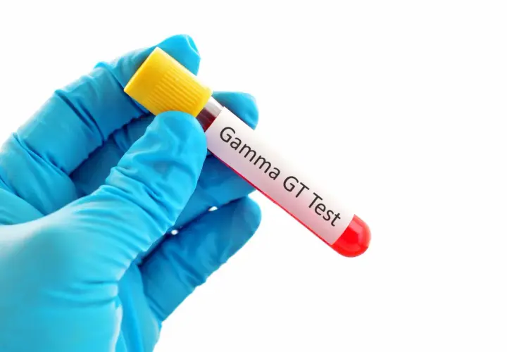 Rękawiczka w niebieskiej rękawicy trzyma probówkę z krwią do badania Gamma GT. Wynik: ggtp podwyższone.
