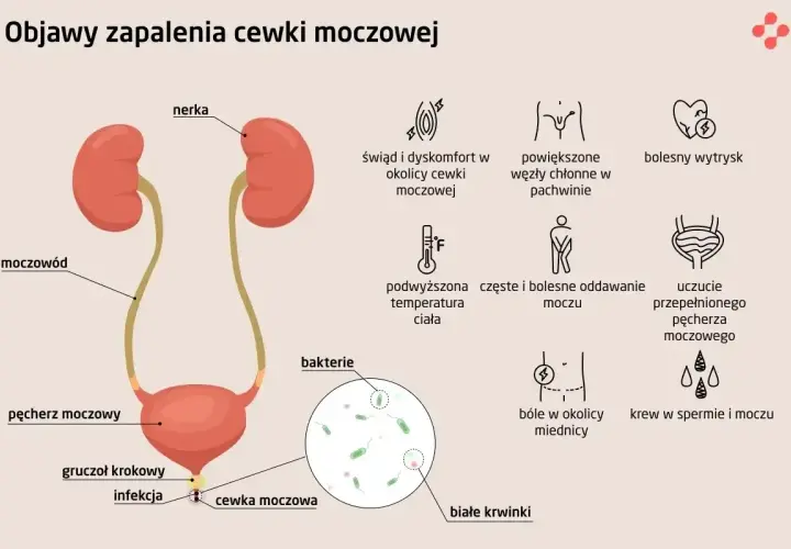 Objawy zapalenia cewki moczowej: świąd, ból, gorączka, krew w moczu, bolesny wytrysk. Infekcja cewki moczowej.