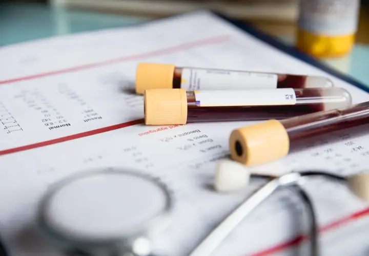 Wyniki badań wskazują na mcv podwyższone. Na stole leżą probówki z krwią, wyniki laboratoryjne i stetoskop.