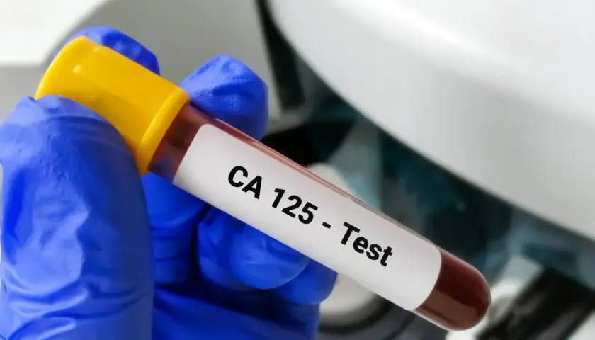 Ręka w niebieskiej rękawiczce trzyma probówkę z krwią z etykietą "CA 125 - Test". To badanie pomaga wykryć pewne schorzenia.