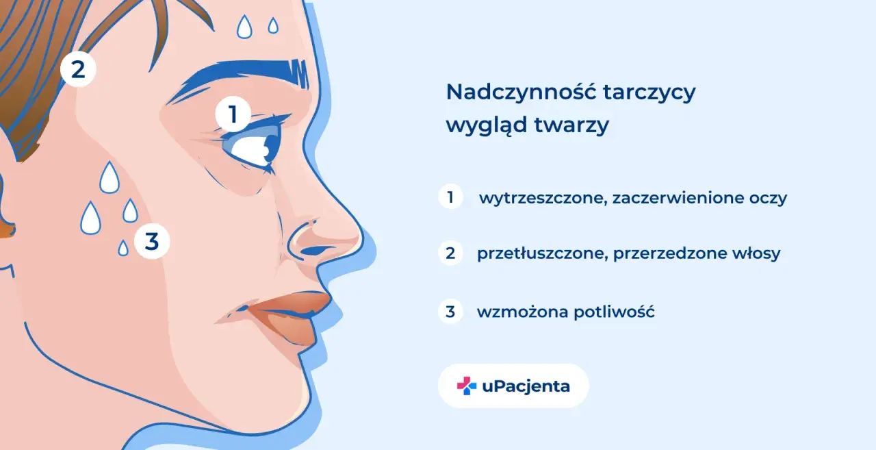 Nadczynność tarczycy objawia się wytrzeszczem oczu (1), przetłuszczonymi włosami (2) i wzmożoną potliwością (3).