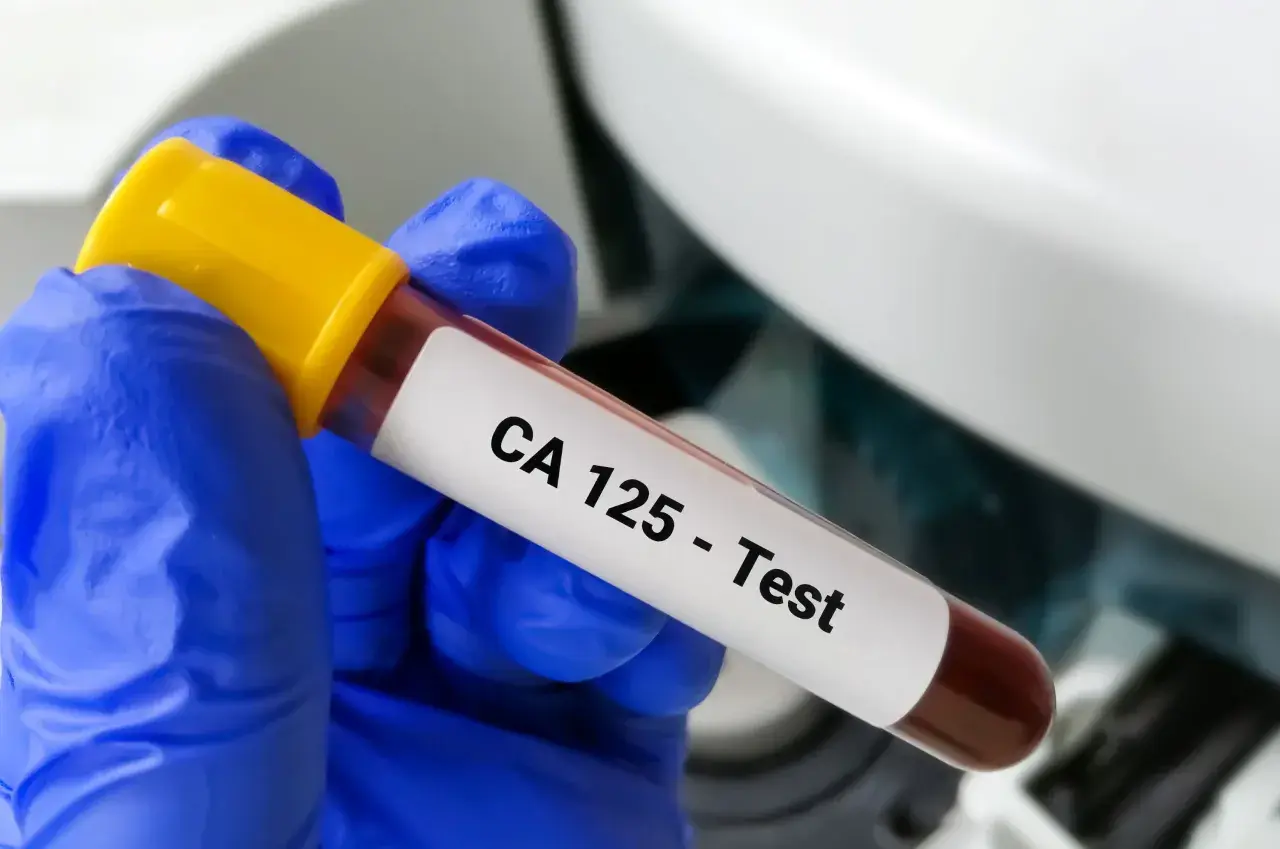 Ręka w niebieskiej rękawiczce trzyma probówkę z krwią z etykietą "CA 125 - Test". To badanie pomaga wykryć pewne schorzenia.