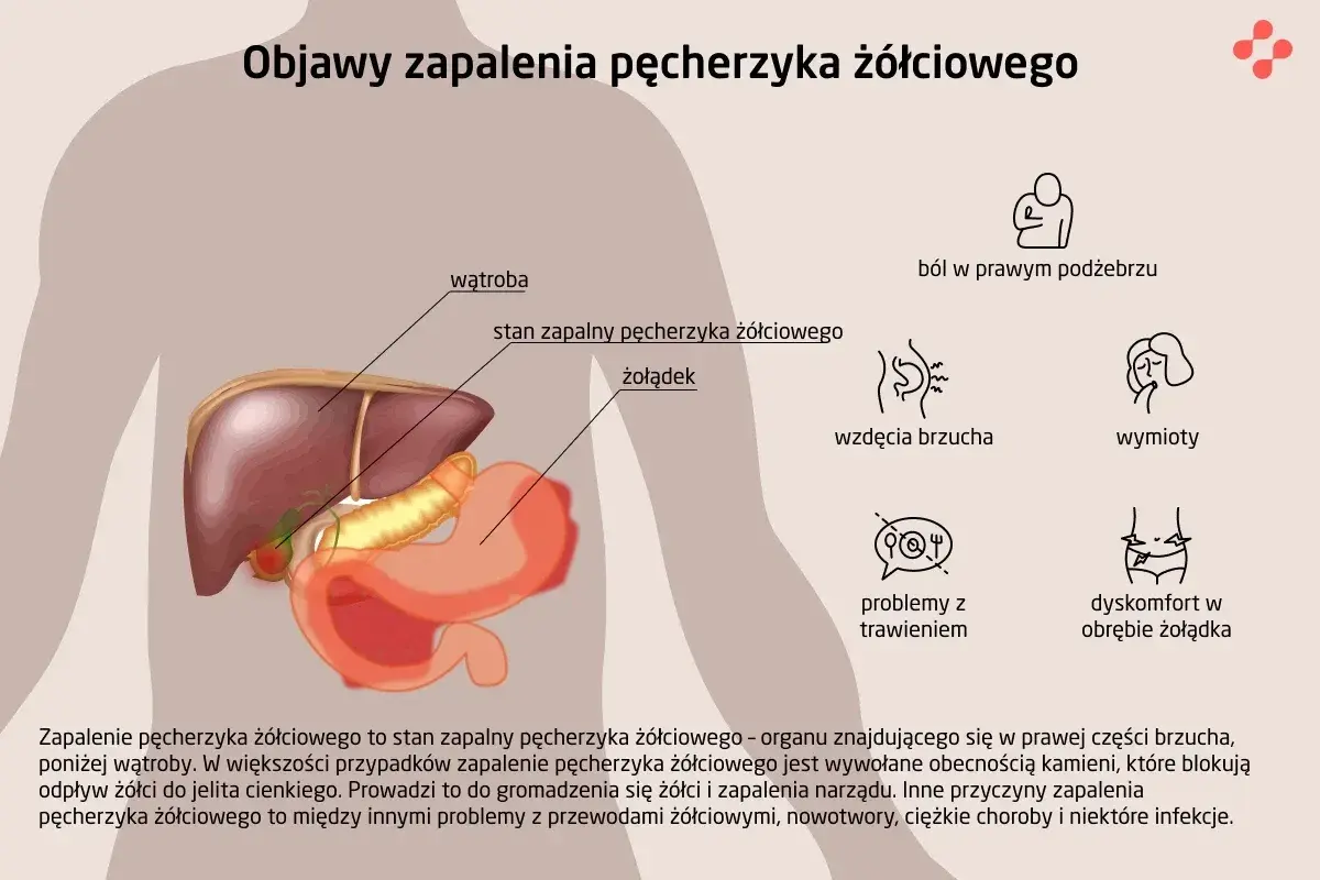Ilustracja przedstawia anatomię jamy brzusznej z zaznaczonymi wątrobą i żołądkiem. Obok wymieniono objawy zapalenia pęcherzyka żółciowego: ból, wzdęcia, wymioty, problemy z trawieniem i dyskomfort.