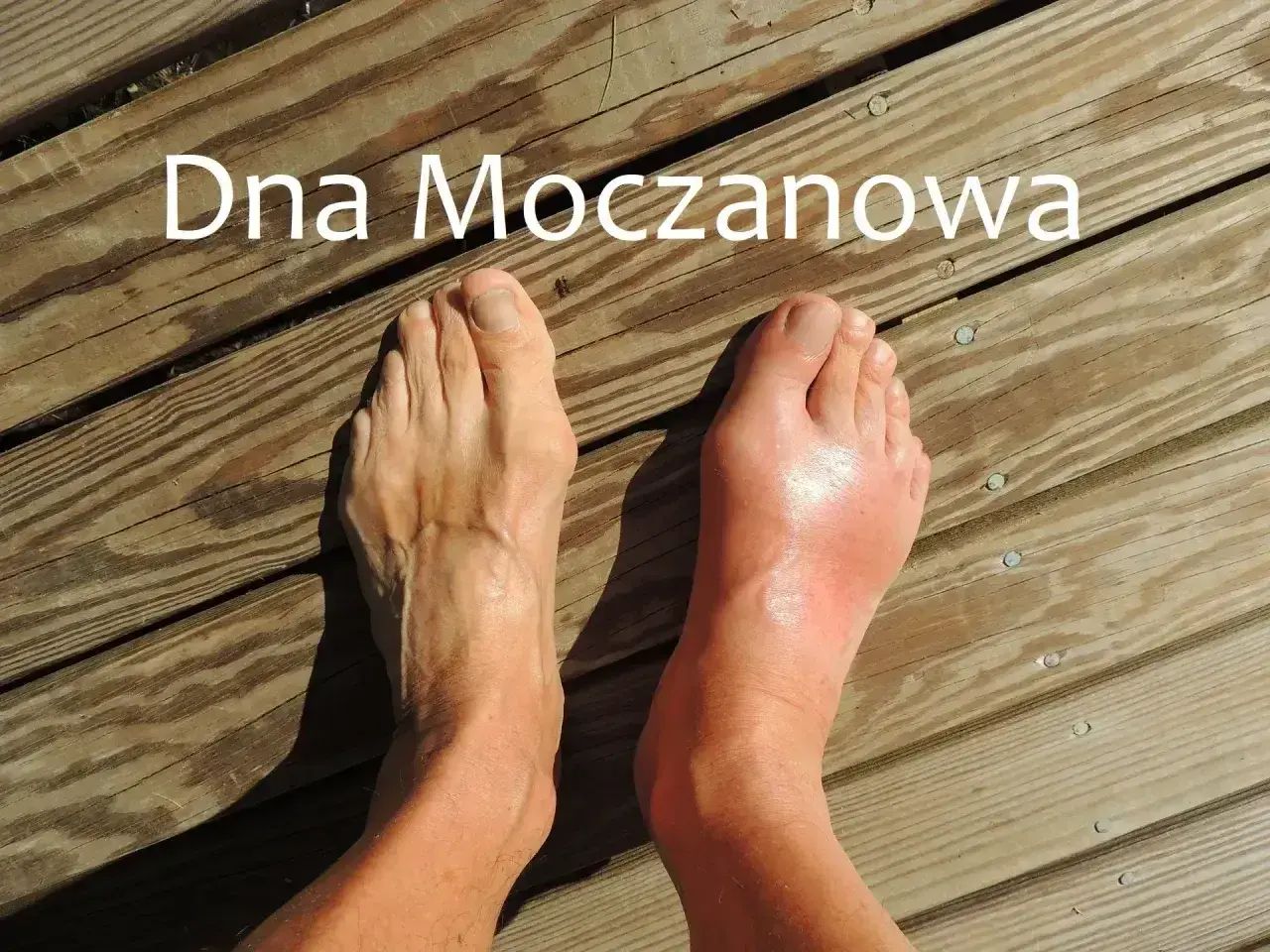 Dwa stopy na drewnianym tarasie. Jedna zdrowa, druga z obrzękiem i zaczerwienieniem, objawem dny moczanowej.
