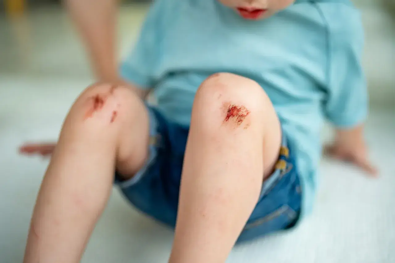 Dziecko z otartymi kolanami. Wczesne objawy tężca mogą obejmować drobne skaleczenia i otarcia, które wymagają uwagi.