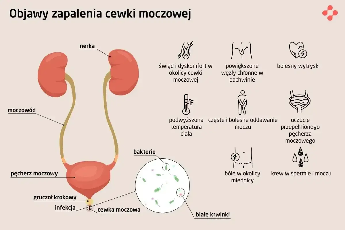 Objawy zapalenia cewki moczowej: świąd, ból, gorączka, krew w moczu, bolesny wytrysk. Infekcja cewki moczowej.