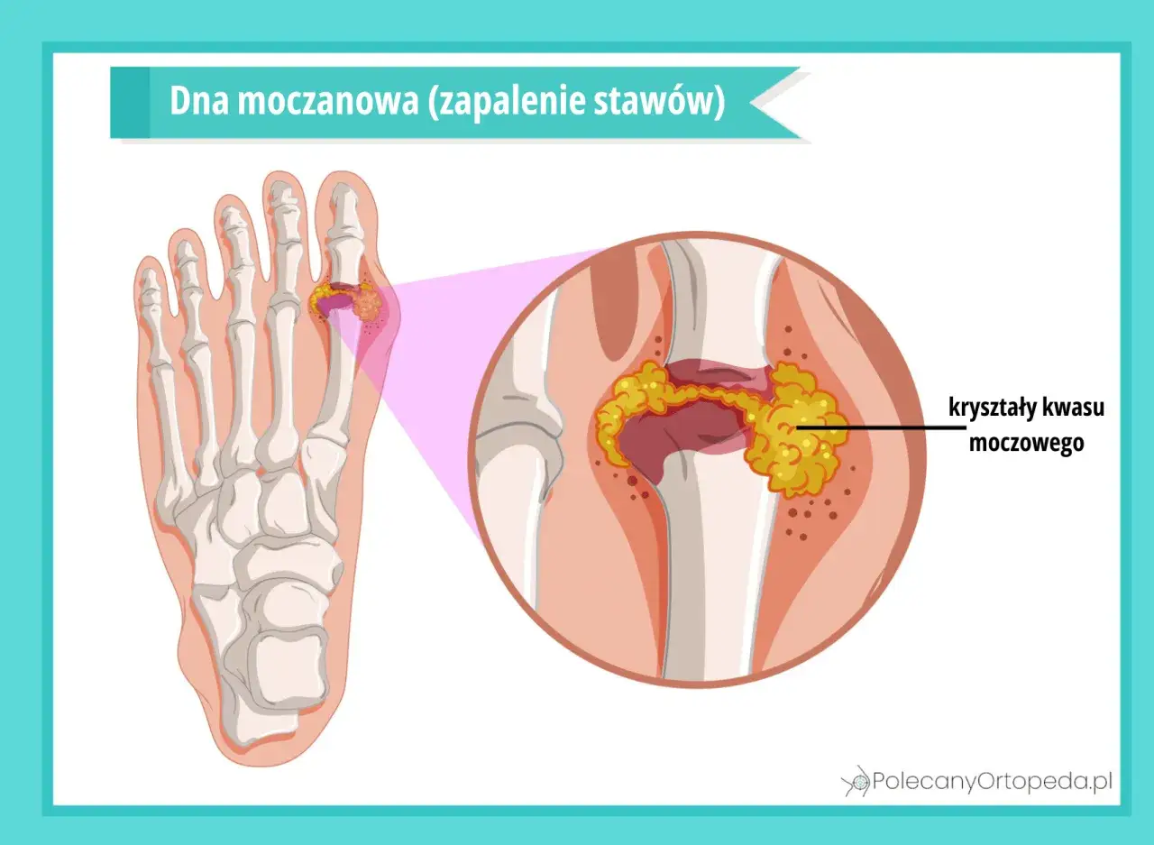 Dna moczanowa to zapalenie stawów spowodowane przez kryształy kwasu moczowego. Ilustracja pokazuje stopę z zaznaczonym stawem palucha, gdzie gromadzą się kryształy.