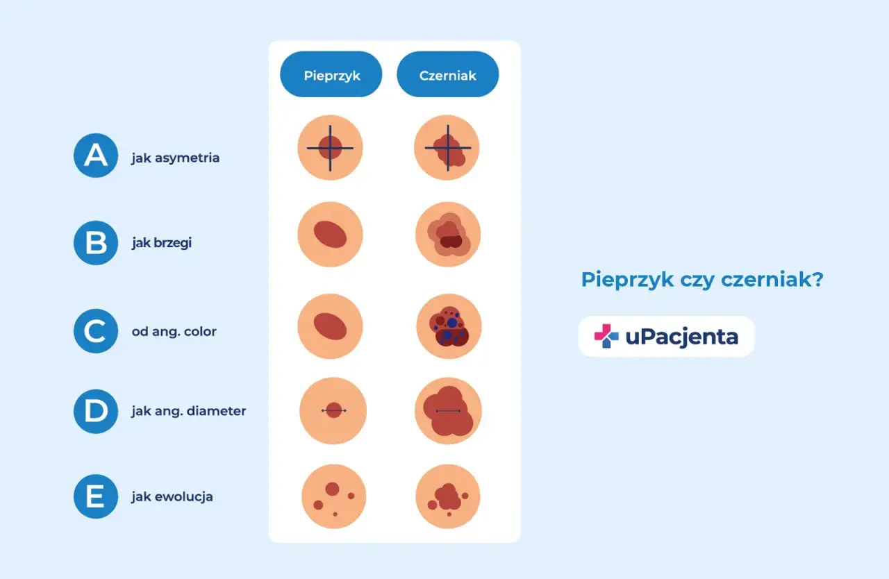 Porównanie cech pieprzyka i czerniaka: asymetria, brzegi, kolor, średnica i ewolucja. Pomaga rozpoznać potencjalne pieprzyki rakowe.