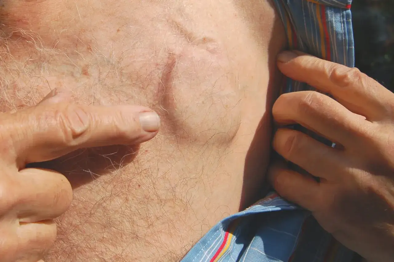 Widoczny implant pod skórą, prawdopodobnie rozrusznik serca, z blizną pooperacyjną.