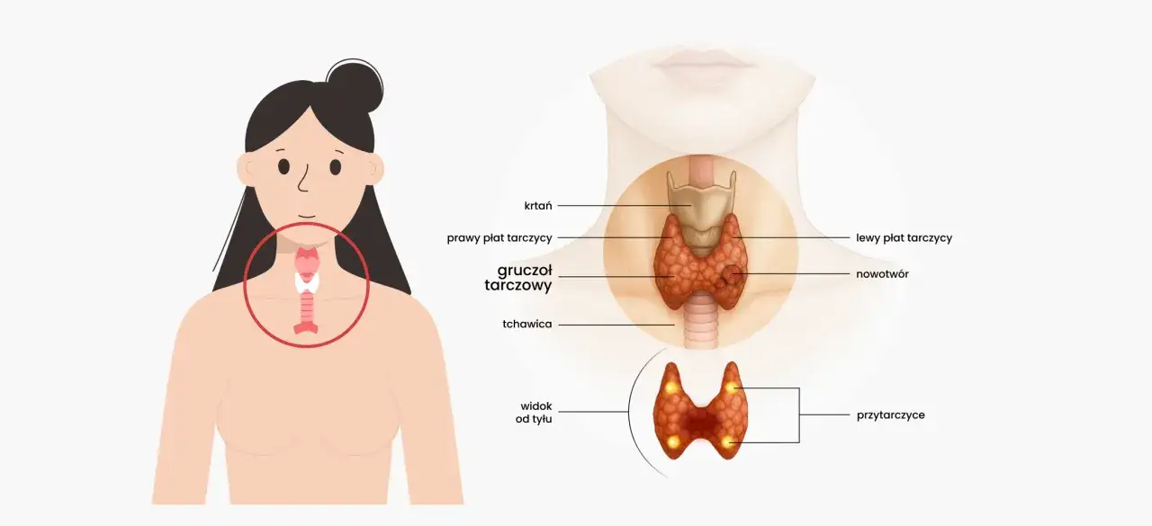 Ilustracja pokazuje, gdzie jest tarczyca, jej budowę i umiejscowienie w szyi. Widoczny jest gruczoł tarczowy z płatami, tchawicą, krtanią i przytarczycami.