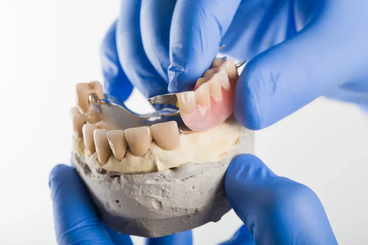 Dentyści dopasowują protezę szkieletową do gipsowego odlewu szczęki.