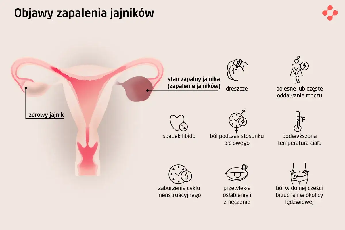 Ilustracja przedstawia budowę narządów rodnych z zaznaczonym zdrowym i zapalonym jajnikiem. Objawy zapalenia jajników to m.in. ból, gorączka, zaburzenia cyklu.