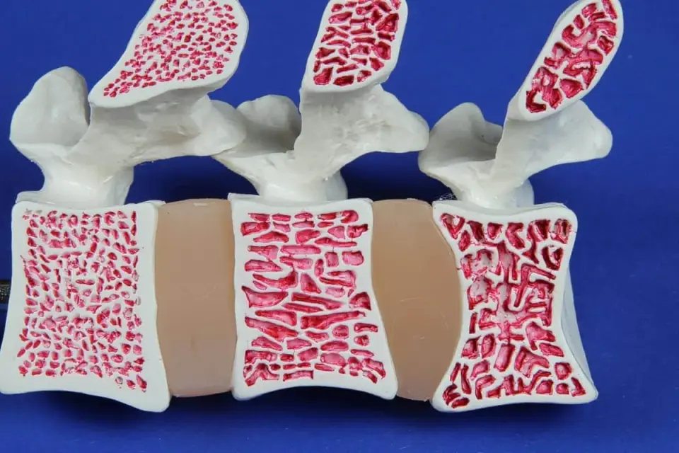 Osteopenia - jak odczytać wynik DXA i ocenić ryzyko złamania?